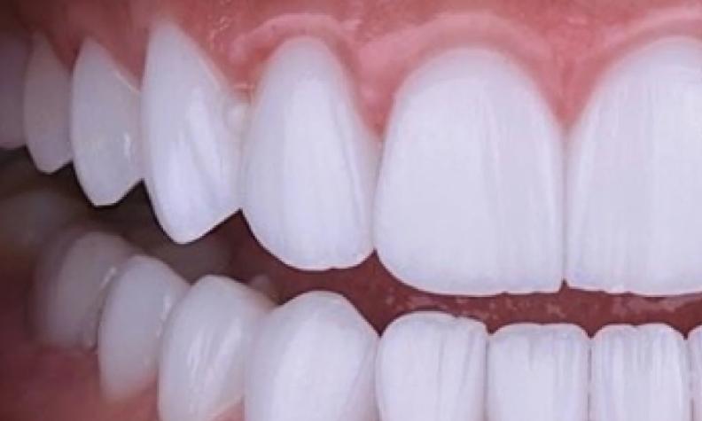 A estética do sorriso entrou no excesso