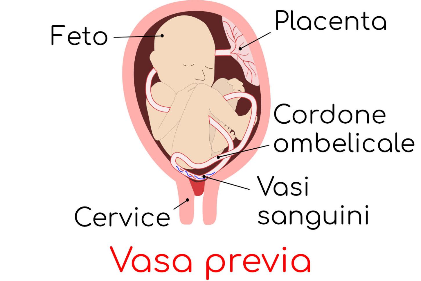 Condição rara na gravidez exige atenção: o que é a vasa prévia e por que o diagnóstico precoce pode salvar vidas