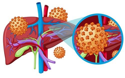 Como as hepatites virais afetam seu fígado?