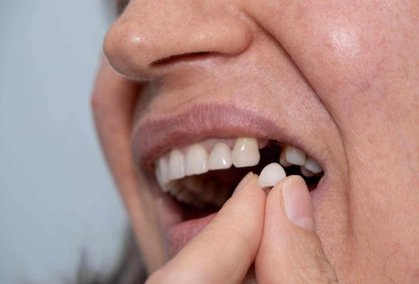 Quem faz bariátrica pode perder os dentes?