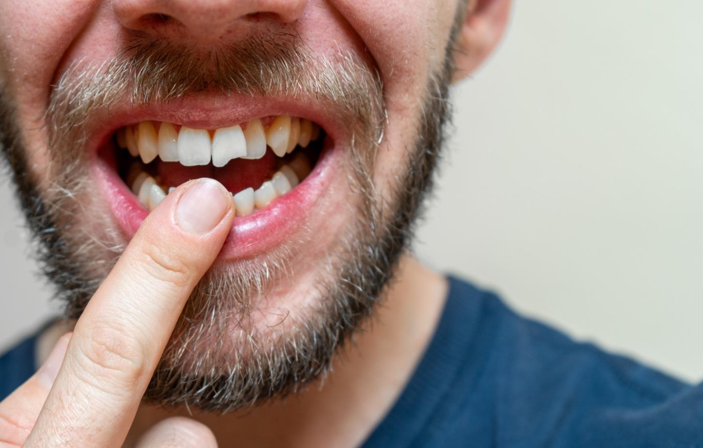 Saiba quais alimentos podem fraturar seu dente