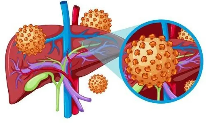 Como as hepatites virais afetam seu fígado?