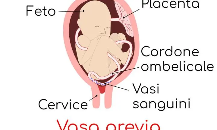 Condição rara na gravidez exige atenção: o que é a vasa prévia e por que o diagnóstico precoce pode salvar vidas