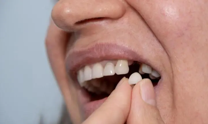 Quem faz bariátrica pode perder os dentes?