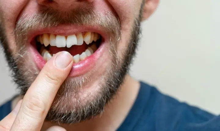 Saiba quais alimentos podem fraturar seu dente